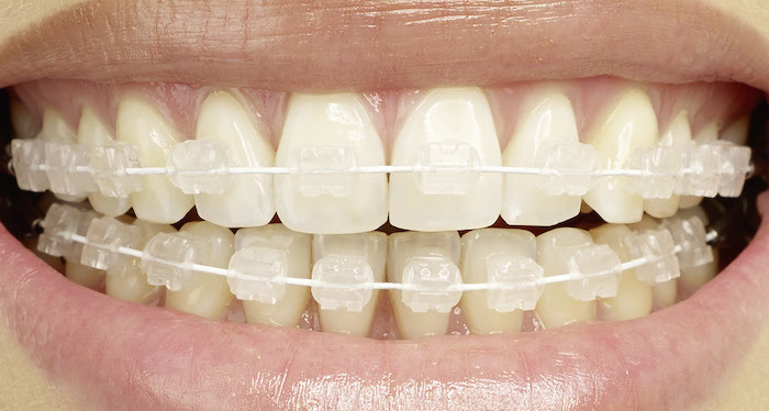 Opciones discretas para alinear los dientes